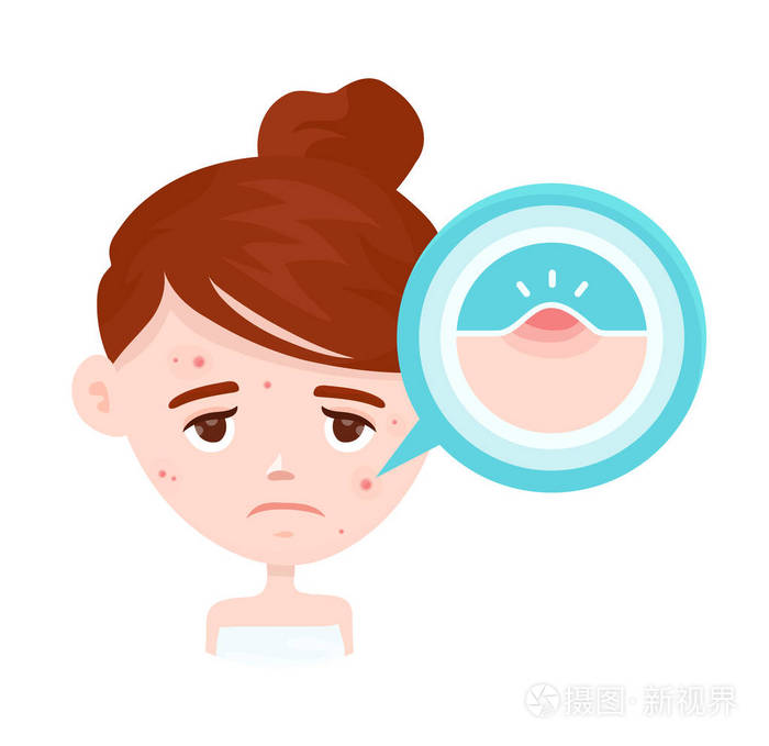 痤疮的数据图表矢量现代平面样式