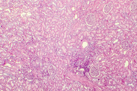 肾动脉透明变性照片