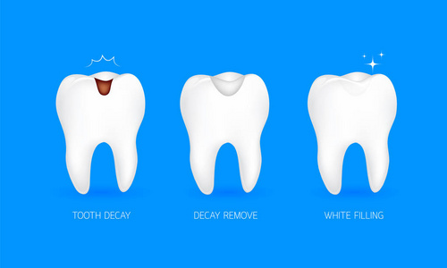 龋病充填的一步。蛀牙 衰变删除和白色填充