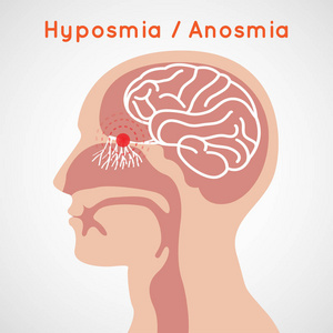 Hyposmia 和嗅觉障碍标志矢量图标设计插画