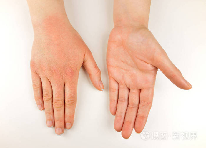 干枯的手由寒冷的天气