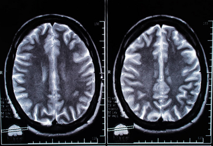 大脑的 x 射线图像计算机断层扫描