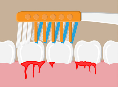 牙周疾病，牙龈出血