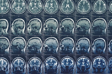 大脑扫描 Mri 或 x 射线或磁共振图像的头。神经病学层析成像概念