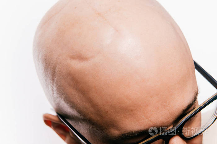 肿瘤术后男性秃头的特写脑肿瘤的放疗及化疗的标记癌症治疗后的幸存者