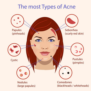 不同类型的痤疮。带有皮肤问题的矢量插图