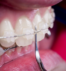 牙医用牙科工具在牙科诊所里用陶瓷支架清洁牙齿。大括号的牙齿的宏观拍摄。正畸治疗。牙科