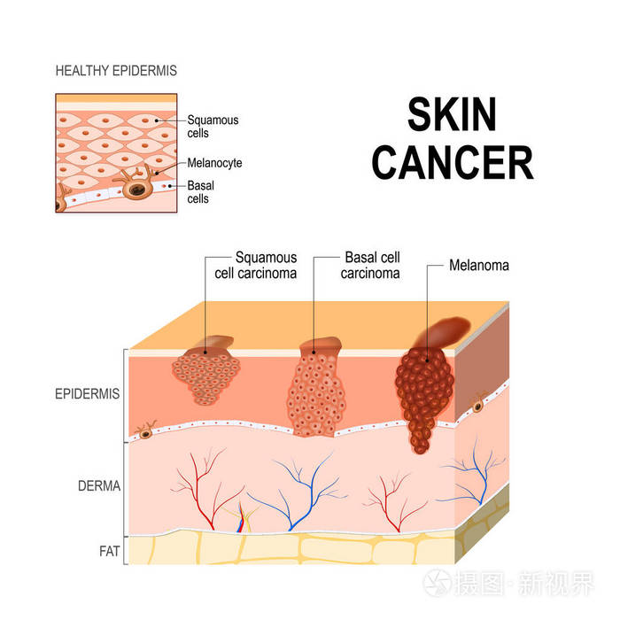 皮肤癌 鳞状细胞癌 基底细胞癌和节插画 正版商用图片0zvh06 摄图新视界 皮肤癌 鳞状细胞癌 基底细胞癌和节插画 正版商用图片0zvh06 摄图新视界