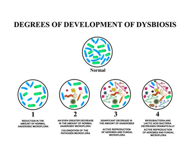 4度的发展 dysbiosis。失调的肠道。大肠。dysbiosis 的结肠。细菌, 真菌, 病毒。信息.孤立背景下的矢量图示