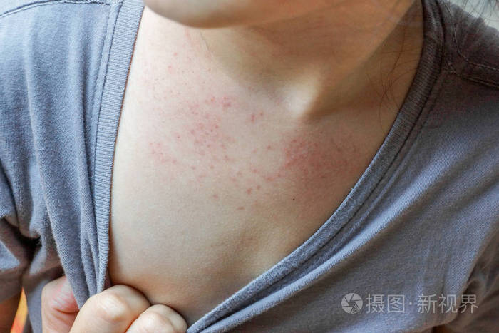 婴儿皮肤上的红疹