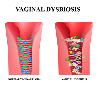  dysbiosis的失调念珠菌病乳酸杆菌, 双歧杆菌。细菌致病菌群。信息.孤立背景下的矢量图示