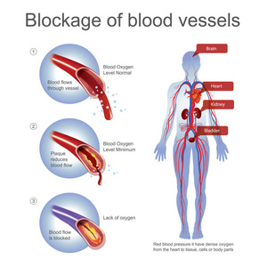 血管堵塞图片