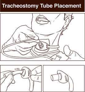 气管切开管放置的矢量图示照片