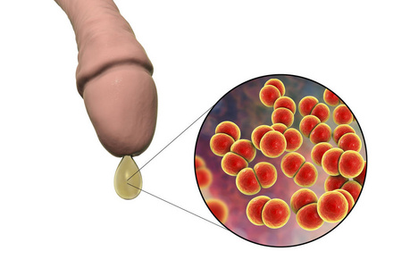 淋病奈瑟菌的男性淋病和特写观点照片