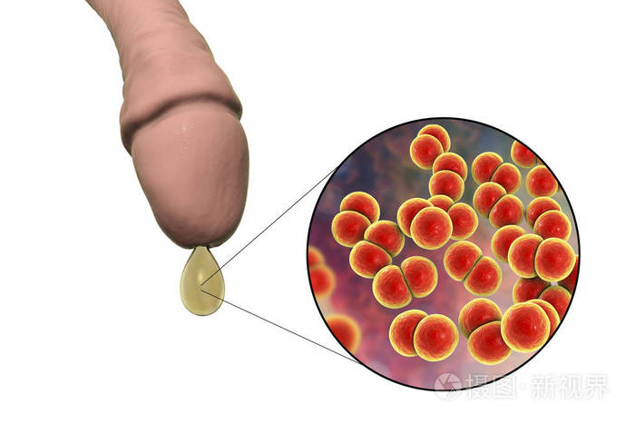 淋病奈瑟菌的男性淋病和特写观点照片 正版商用图片103w60 摄图新视界