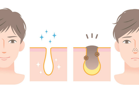 鼻子堵塞清洁毛孔和堵塞毛孔的年轻男子的脸上.男士护肤前后照片