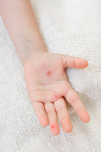 患有水痘的孩子的手。 水痘手上的水泡