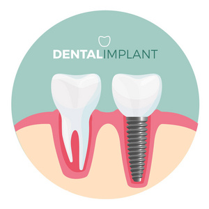 有标题的牙种植标语牌在向量例证