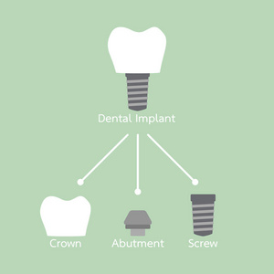 牙种植体的结构与所有部分拆卸, 冠, 基台, 螺丝