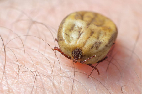 满腔热血坐在人体皮肤上的蜱虫照片