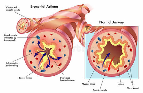 支气管哮喘