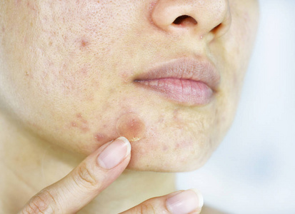 面部皮肤问题, 近距离女性脸上有白石丘疹和痤疮补丁, 疤痕和油性油腻