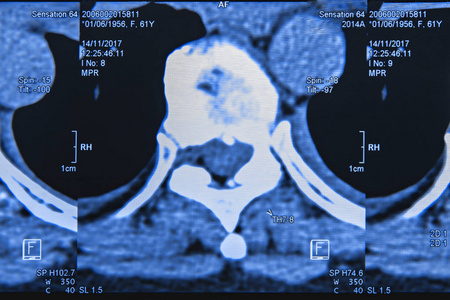 脊柱 Mri x 线