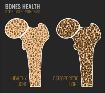 骨质疏松骨图像