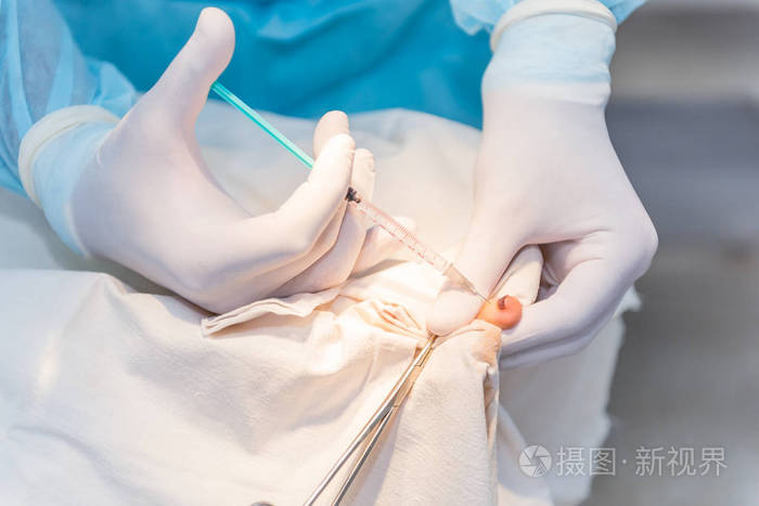 麻醉用注射器的手麻醉的p