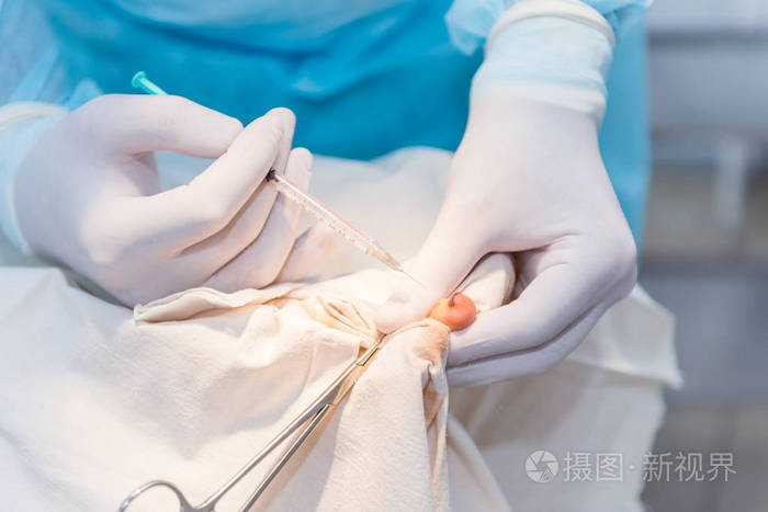 麻醉用注射器的手, 麻醉的 p