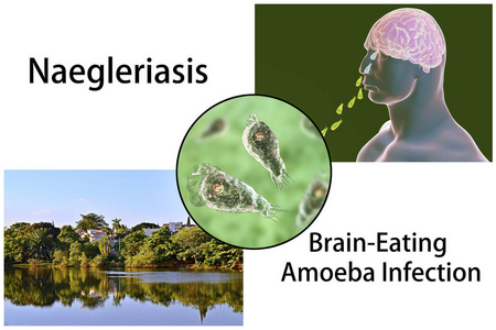 脑进食阿米巴虫感染, naegleriasis照片