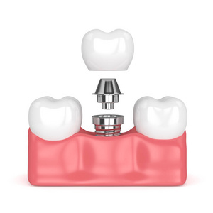 3d 牙种植的牙齿呈现