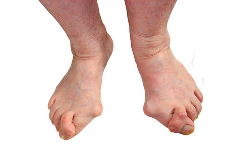 连接大脚趾的关节变形光脚,在木棕色地板上有拇外翻问题.