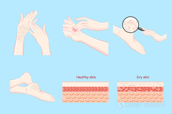 健康与干燥皮肤概念