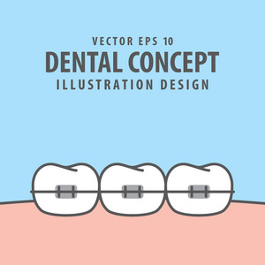 在蓝色背景上的正畸牙齿插图向量。Denta