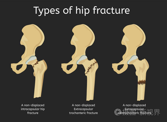 髋部骨折的类型