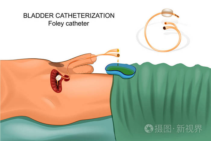 导尿管膀胱插管插画-正版商用图片10u4tf-摄图新视界