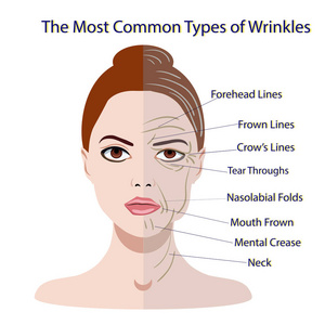 常见的面部皱纹类型。整容手术妇女面部护理
