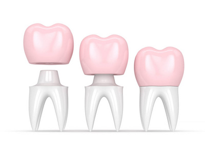 3d 补冠修复牙的修复