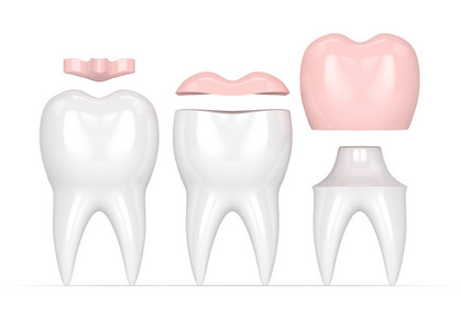 3d 不同类型补牙牙的牙齿呈现