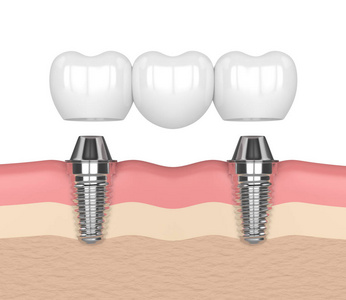 3d. 植入物支撑牙桥