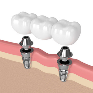 3d. 植入物支撑牙桥