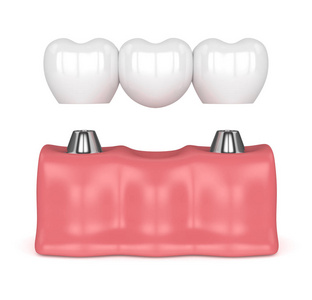 3d. 牙桥植入物的呈现