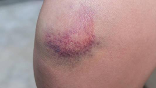 年轻女子膝盖上的瘀伤。