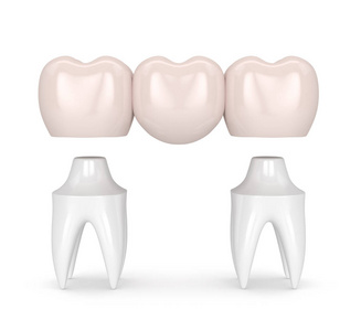 3d 牙科冠牙桥的渲染