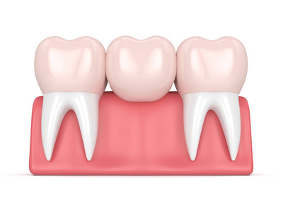 3d 牙科冠牙桥的渲染