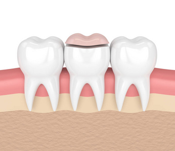 3d 牙齿嵌充填