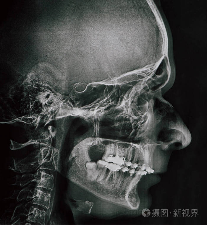 人颌骨轮廓x线