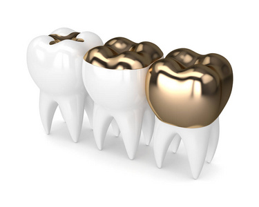 3d 不同类型牙齿金填充牙的呈现