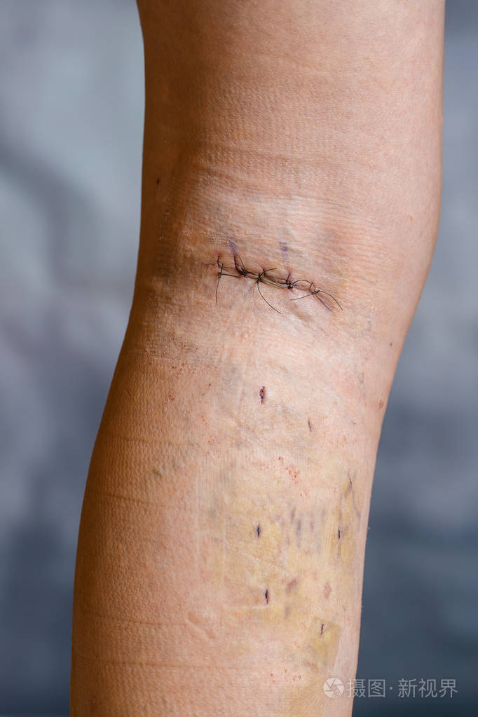 静脉手术后的女人腿